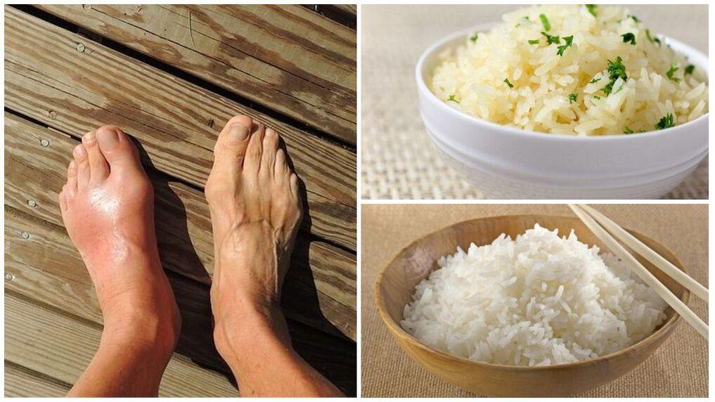 Podagra sergantiems pacientams rekomenduojama dieta iš ryžių. 